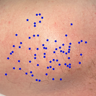 electrolysis on shoulder