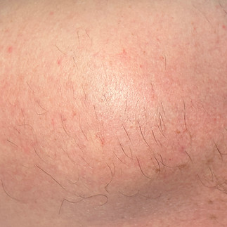 Electrolysis on shoulder