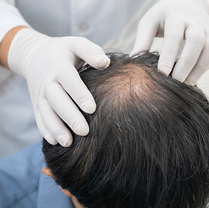Veradermics Male Pattern Baldness Treatment
