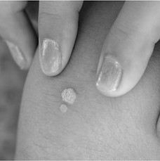 Common Warts