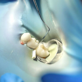 Painless Tooth Extraction Process.jpg