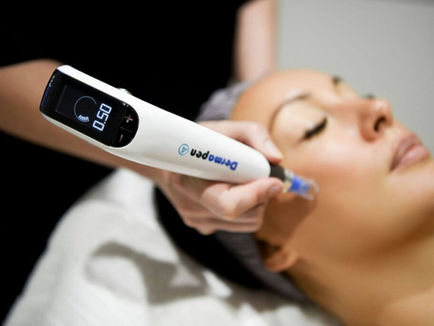Correcting Acne Scars: Professional Advice