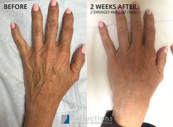 Hand-Rejuvenation-56947-62yo-Caucasian-Female-Before-and-After-2Syringes-Radiesse-2weeks.j