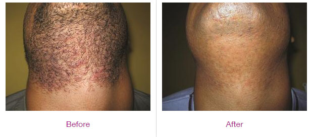 Laser Hair Removal