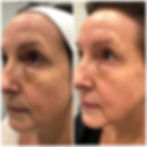 Chemical Peels in Allentown and Warminster