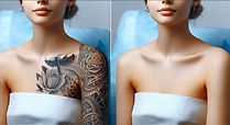 Before and after image of tattoo removal by Alternative laser health