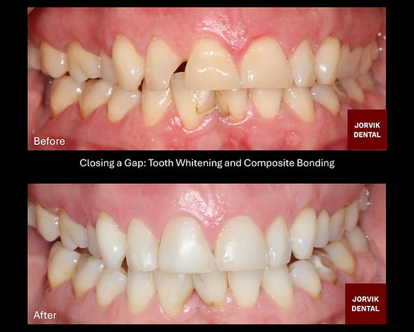 Composite Bonding. Tooth Whitening