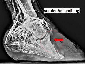 Venogramm vorher-Text.jpg