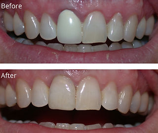 Dental Crown Before and After