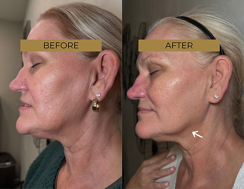 INDIBA BeforeAfter (1).png
