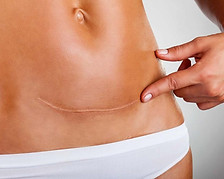 scarring-after-surgery-1024x635.jpg