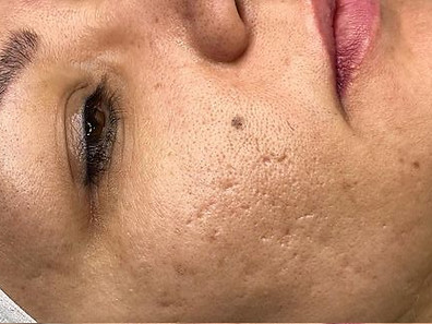 The Ultimate Guide to Oxygen Facial Treatment_edited.jpg