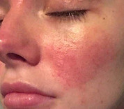Beautician battling rosacea reveals the products that banish redness.jpeg