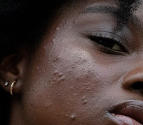 A Beauty Expert On How To Approach Acne & More.jpeg