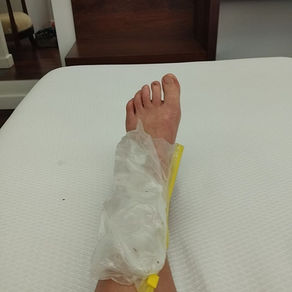 Gros plan sur une cheville blessée avec un sac de glaçons