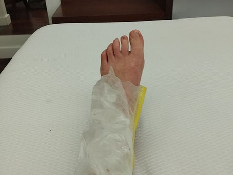 Gros plan sur une cheville blessée avec un sac de glaçons