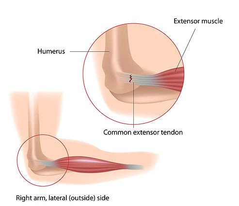 tennis elbow massage