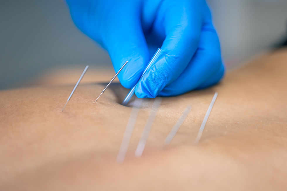 A practitioner wearing blue gloves carefully performs acupuncture, inserting thin needles into the patient's skin to promote relaxation and healing.
