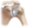 Abbildung einer anatomischen Schulterprothese
