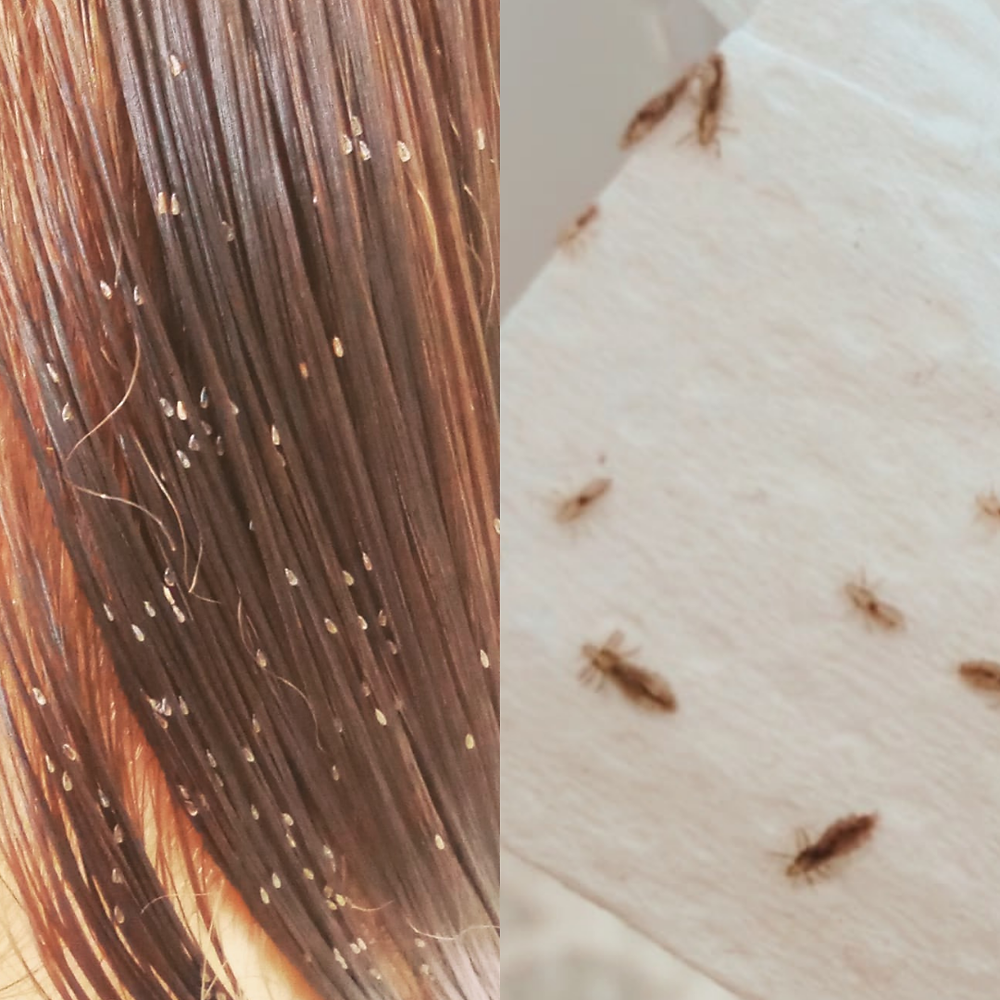 Head Lice and Nits or Lice eggs