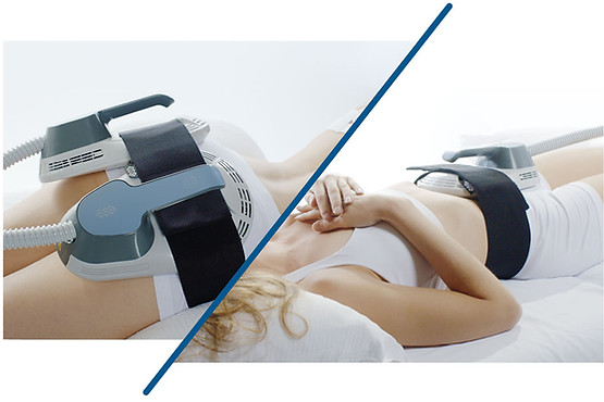 Euphoria Hifem zsírbontás.jpg