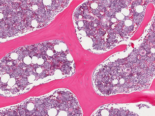 Bone Marrow Concentrate (BMC) for Pain Relief and Improved Function