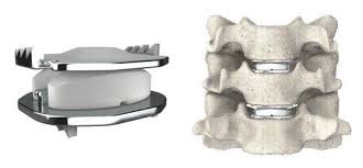 the disc replacement: a non-fusion alternative to neck pain