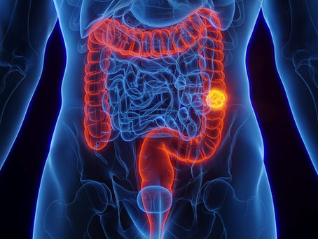 SUS adota novo exame para detectar câncer de intestino antes de sintomas