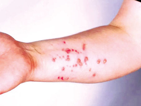 Secretaria de Saúde descarta caso de monkeypox em paciente potiguar