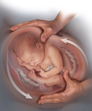 Is Your Baby Breech? Get The Bottom Line On A Great Option - External Cephalic Version (ECV)! Plus T