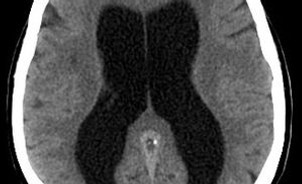 Hydrocephalus_(cropped).jpg