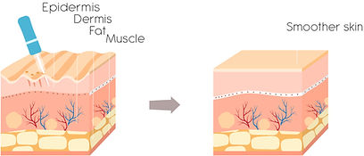 Microneedling.jpg