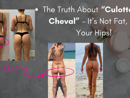 Unlock the Truth About “Culotte de Cheval” – It’s Not Fat, It’s Your Hips!