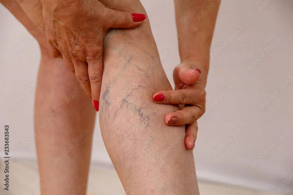 Varicose Veins and Homeopathy: A Gentle Yet Effective Solution