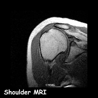 Burd PT Rotator Cuff Tear MRI