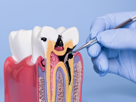 Gingivite et parodontite : comprendre la différence avant qu'il ne soit trop tard