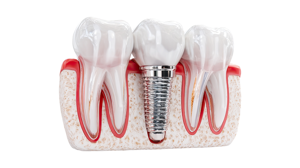 Parodontite traitée :peut-on avoir des implants dentaires ?
