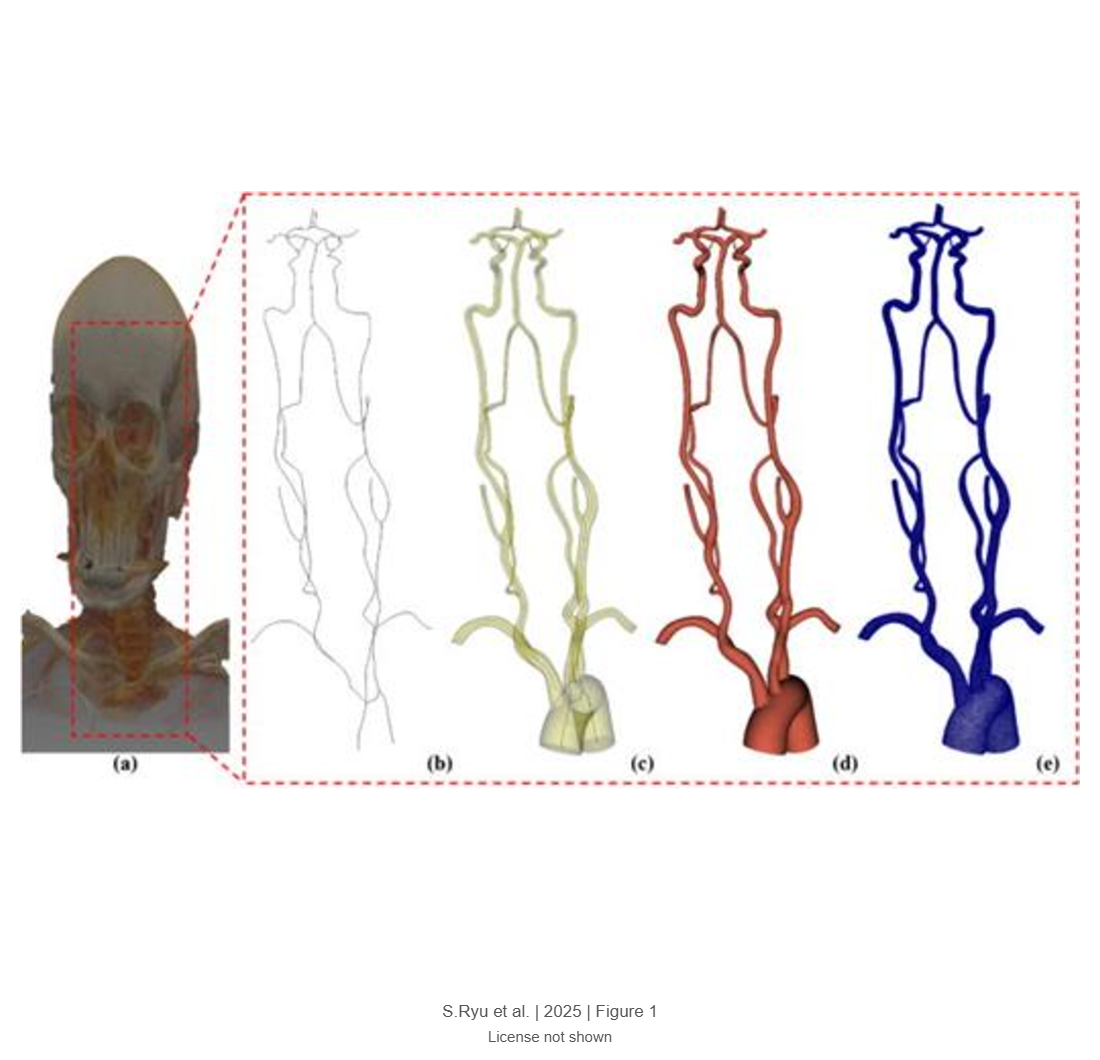 Impact of temporary common carotid artery strangulation on hemodynamics during surgical clipping of middle cerebral bifurcation aneurysms