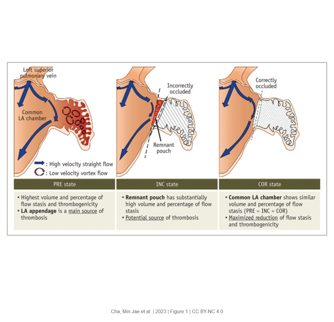Correct Closure of the Left Atrial Appendage Reduces Stagnant Blood Flow and the Risk of Thrombus Formation A Proof-of-Concept Experimental Study Using 4D Flow Magnetic Resonance Imaging