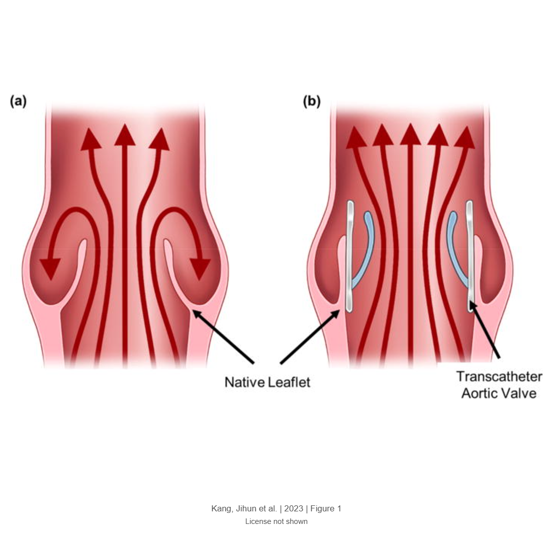 Sinus hemodynamics after transcatheter aortic valve implantation: Effect of native leaflet length and aortic sinus diameter