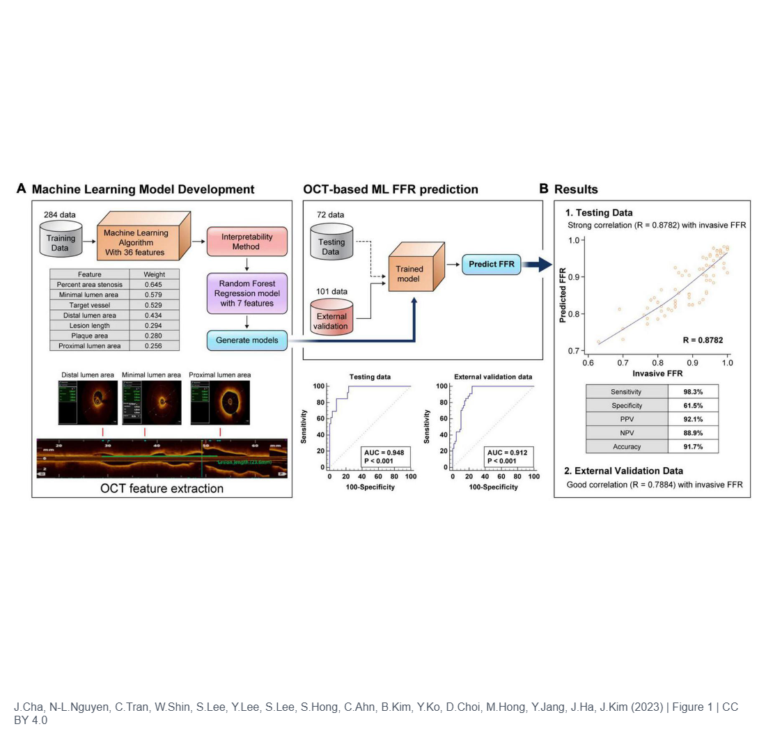 Assessment of Fractional Flow Reserve in Intermediate Coronary Stenosis Using Optical Coherence Tomography-Based Machine Learning