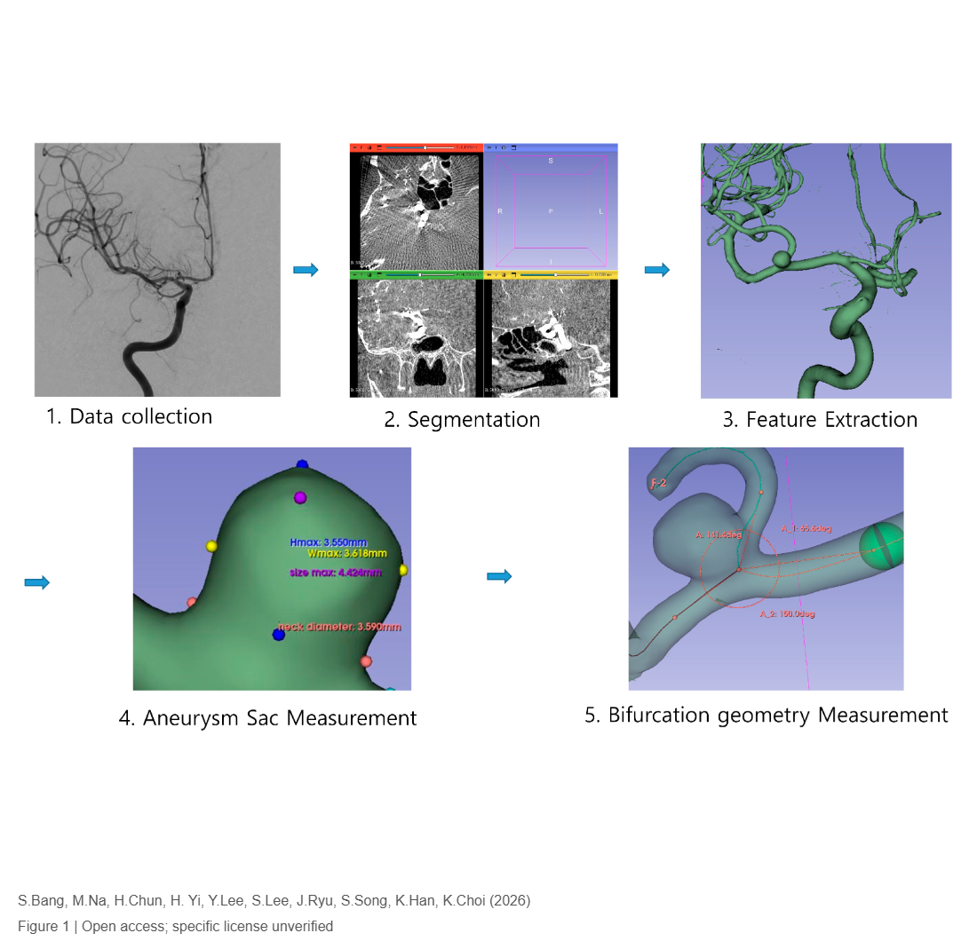 Middle Cerebral Artery Bifurcation Geometry and Aneurysm Formation: A Propensity Score-Matched 3D Rotational Morphometry Study