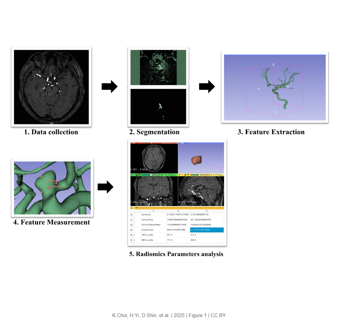 Influence of Fetal-Type Posterior Cerebral Artery on Morphological Characteristics and Rupture Risk of Posterior Communicating Artery Aneurysms: A Radiomics Approach