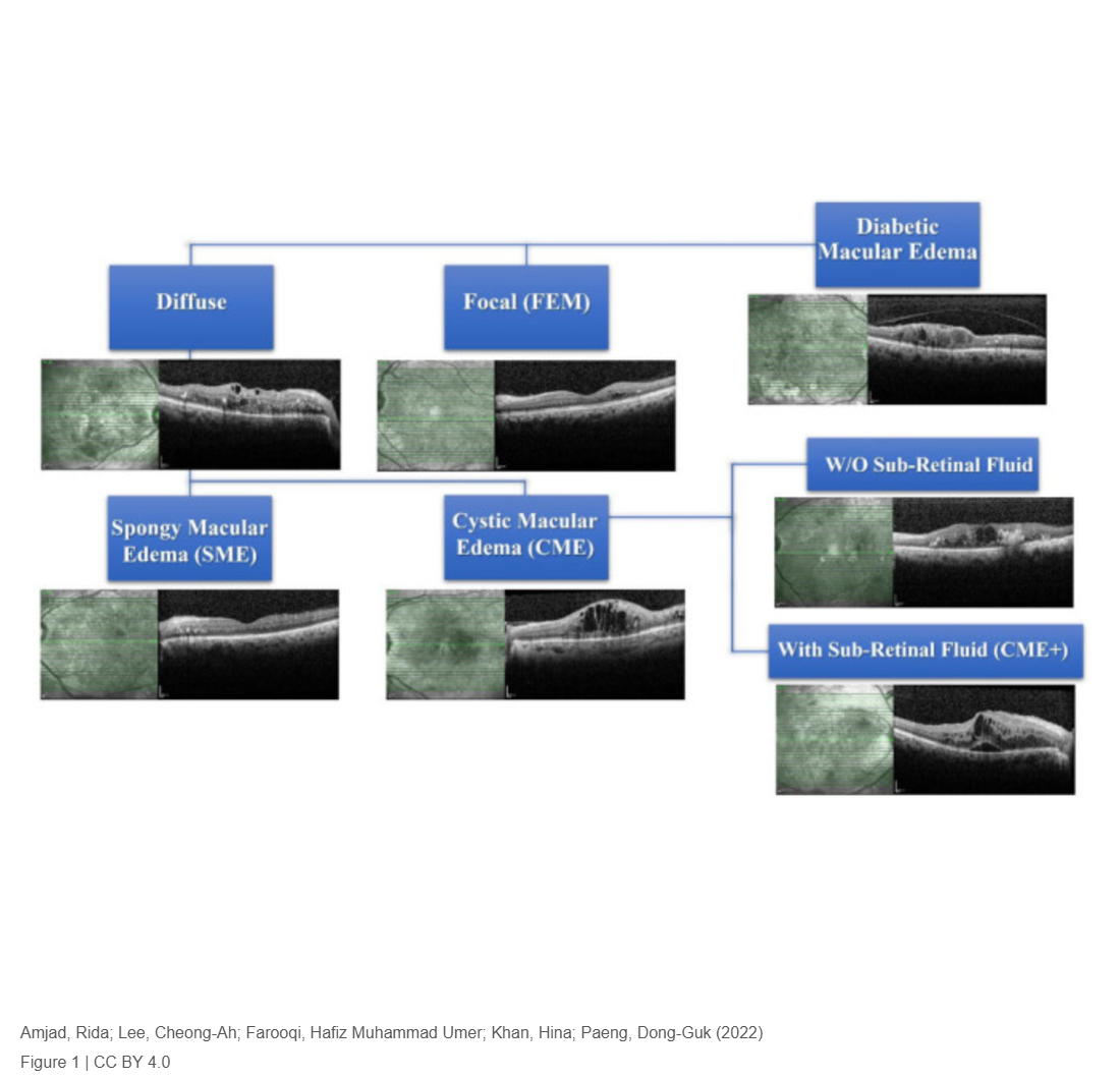 Choroidal Thickness in Different Patterns of Diabetic Macular Edema