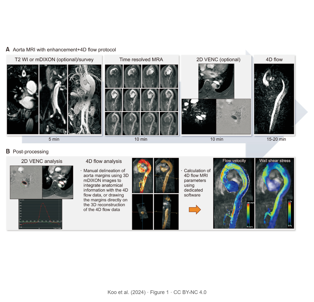 Evaluation of Aortic Diseases Using Four-Dimensional Flow Magnetic Resonance Imaging