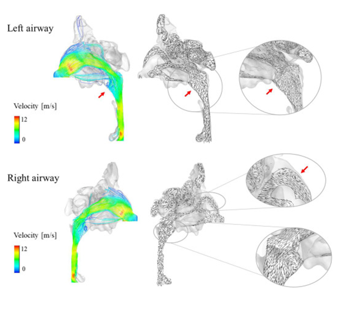 Generating synthetic CT images from unpaired head and neck CBCT images and validating the importance of detailed nasal cavity acquisition through simulations