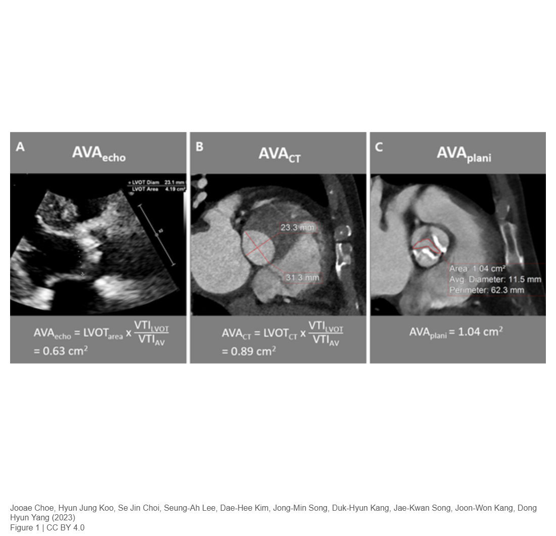 Differences in aortic valve area measured on cardiac CT and echocardiography in patients with aortic stenosis