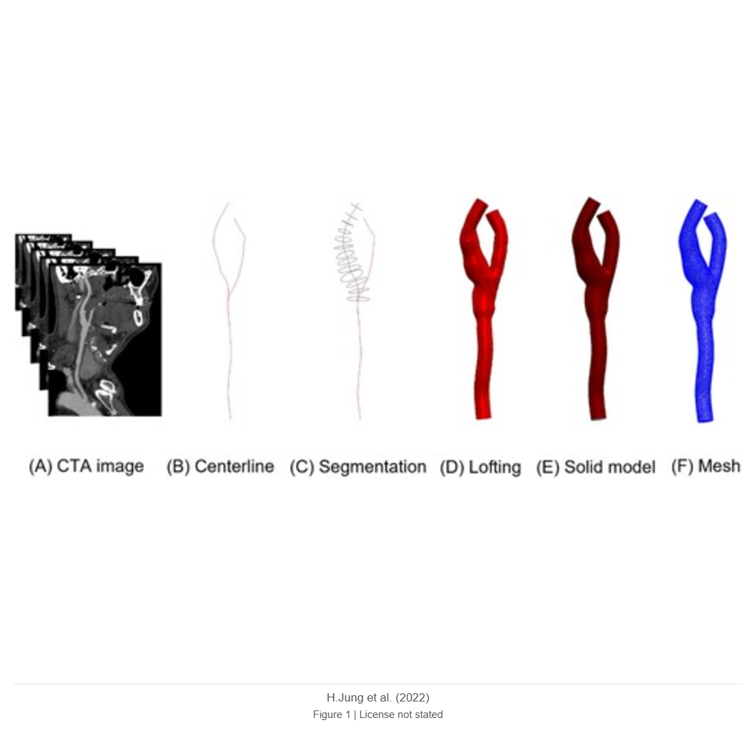 Comparison of haemodynamics in carotid endarterectomy: primary closure versus patch angioplasty
