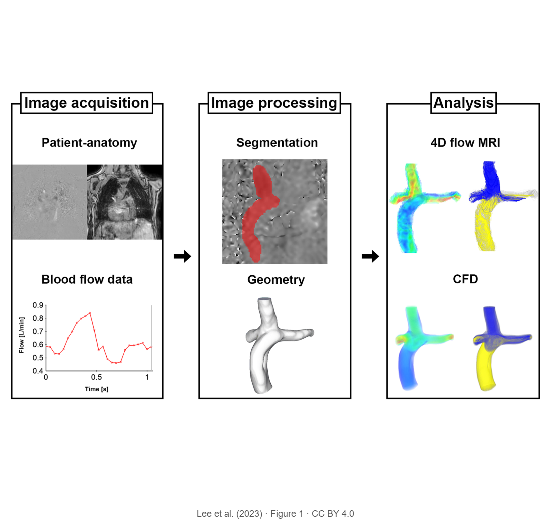 Characterization of baseline hemodynamics after the Fontan procedure: a retrospective cohort study on the comparison of 4D Flow MRI and computational fluid dynamics