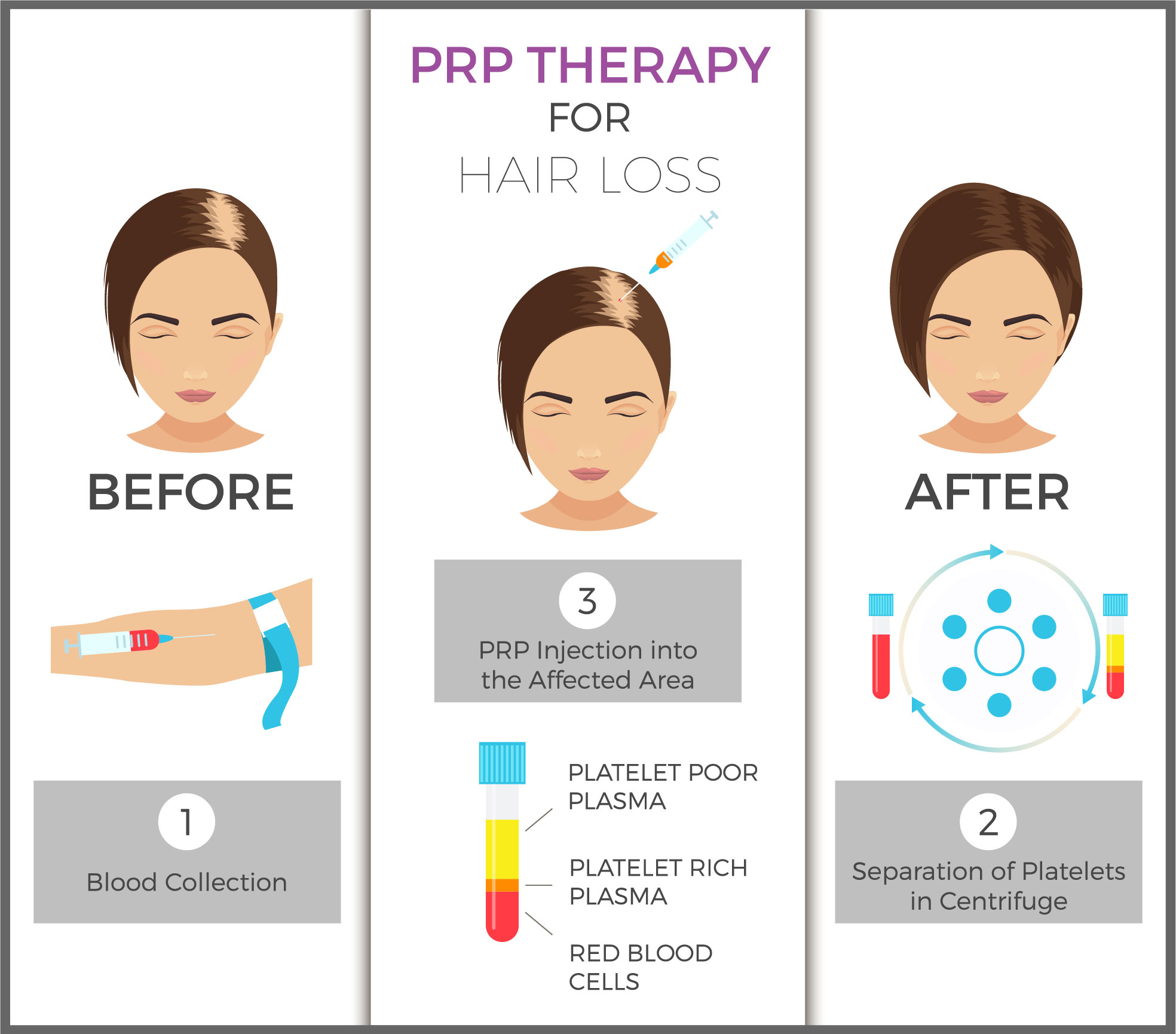 Platelet Rich Plasma Prp For Hair Loss